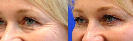 Botox kırışıklık tedavisi
