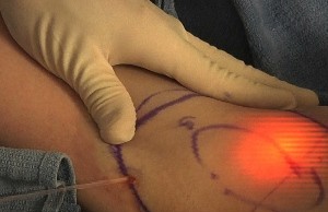 Hiperhidrozis, Aşırı terleme, Lazer
